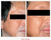 Vitiligo skin disorder treatment within 15 days